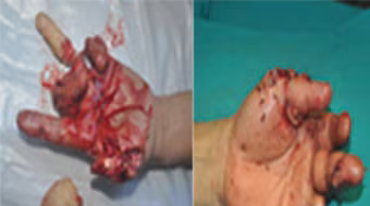 Nối ngón tay bằng kỹ thuật vi phẫu 