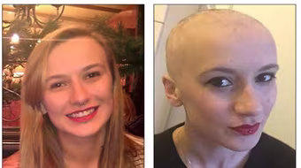 Rụng hết tóc vì quá căng thẳng