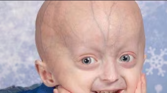 Pháp đã tìm ra hội chứng lão hóa sớm