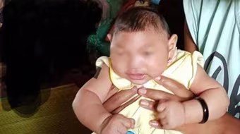 Phát hiện thêm 2 trẻ bị chứng đầu nhỏ bẩm sinh tại Đắc Lắk
