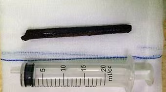 Hải Dương: Uống rượu say đi xe đạp, bị cành cây đâm xuyên hộp sọ