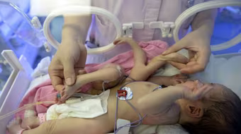 Trung Quốc: Phẫu thuật thành công bé trai 4 tay, 4 chân