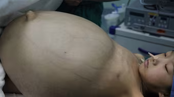 Cận cảnh ca mổ u quái Teratoma khổng lồ ở Trung Quốc