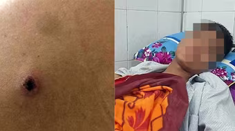 Bị bắn trúng bả vai khi đi ăn cháo đêm