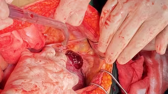 Hà Nội: “Báo động đỏ” toàn viện cứu sống thần kỳ sản phụ vỡ thai, chảy máu ồ ạt