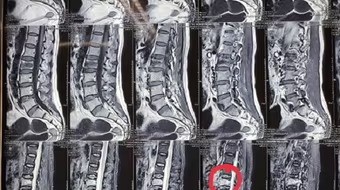 Nhiều bệnh nhân bị lún, xẹp đốt sống được điều trị hiệu quả bằng... bơm xi măng 