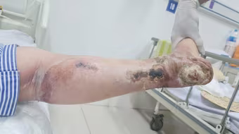 Người phụ nữ 40 tuổi phải cắt cụt 1/3 chân do biến chứng của đái tháo đường