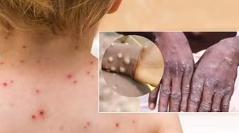 Bộ Y tế họp khẩn cùng WHO: Việt Nam chưa có ca bệnh đậu mùa khỉ nhưng nguy cơ rất lớn