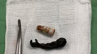 Gắp ra cánh tay đồ chơi siêu nhân bằng nhựa, đầu bút từ âm đạo bé 5 tuổi