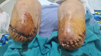 Nam bệnh nhân phải cắt cụt hai chân vì biến chứng của đái tháo đường