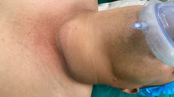 Chủ quan vì nghĩ u tuyến giáp lành tính không cần mổ, nam bệnh nhân diễn biến nặng