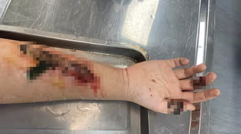 Đắp lá chữa vết thương do mảnh kính đâm trong dịp nghỉ lễ, nam thanh niên suýt hoại tử cánh tay