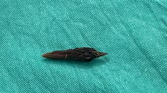 Người phụ nữ bị thủng ruột do nuốt hạt khi ăn yến chưng cùng táo đỏ