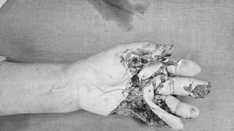 Bé trai 6 tuổi bị lóc hết da dương vật do quần bị cuốn vào máy ép nước mía