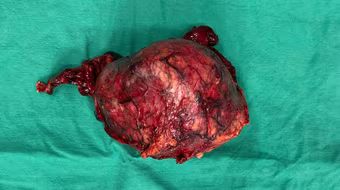 Người phụ nữ bất ngờ phát hiện có khối u thận khổng lồ