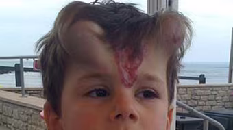 Cậu bé 5 tuổi có 2 sừng lớn trên trán