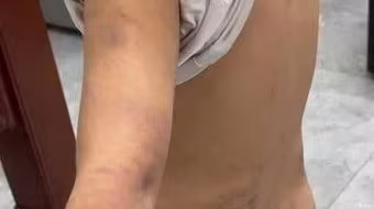 Xác minh hình ảnh bé trai bị đánh tím người tại Hưng Yên