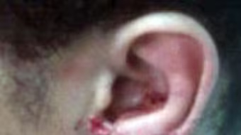 Đeo hoa tai bị cướp giật rách tai