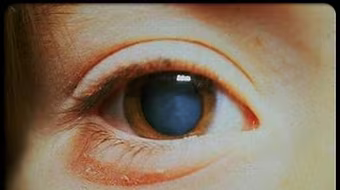 Hút thuốc lá làm tăng nguy cơ đục thủy tinh thể