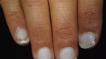 Móng tay nói gì về sức khỏe của bạn?