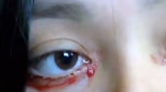 Gặp cô gái khóc ra ...máu