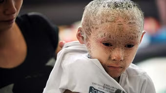 Đáng thương cậu bé người cá ở Trung Quốc