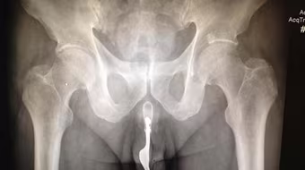 Cụ ông "tự sướng" bằng cách nhét cả chiếc dĩa vào “cậu nhỏ”