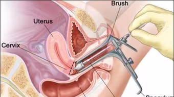 Dấu hiệu cảnh báo ung thư cổ tử cung
