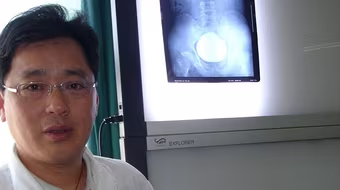 Choáng với viên sỏi nặng hơn 1 cân trong bàng quang