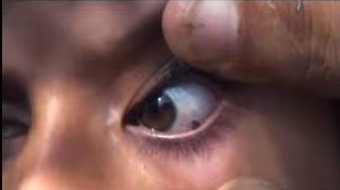 Bé gái khóc ra đá thay vì nước mắt 