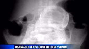 Bào thai hoá đá nằm 44 năm trong bụng cụ bà
