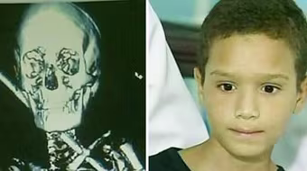 Vẫn sống sót dù bị thanh sắt 60 cm đâm xuyên người 