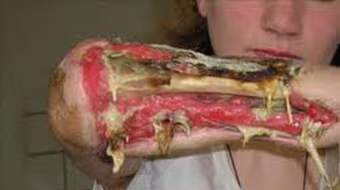 Khủng khiếp ma túy tự chế “cá sấu”: Rẻ, "phê" nhưng cực độc