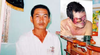 Biến dạng mặt vì… tẩy nốt ruồi