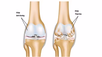 Những điều cần biết về cách chữa trị bệnh thoái hóa khớp