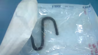 Bé gái thủng trực tràng vì móc sắt