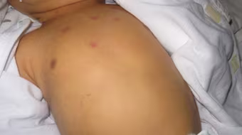 Bé sơ sinh nguy kịch do cắt dây rốn bằng kéo sinh hoạt