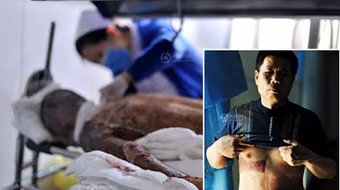 Xót xa cảnh cha già xẻ da cứu con gái bỏng 90%