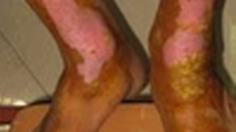 Con nợ tiền không trả, mẹ bị đốt cháy chân