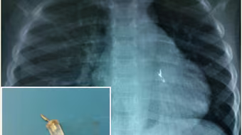 Phát hoảng với những ca "nuốt" bóng đèn của trẻ em