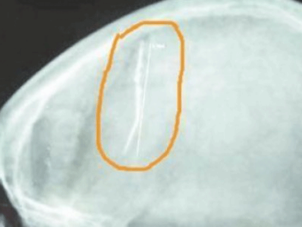 Kim gỉ trong đầu suốt nhiều năm