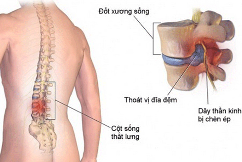 Kịp thời điều trị để tránh nguy hiểm khi bị thoát vị đĩa đệm ảnh 1