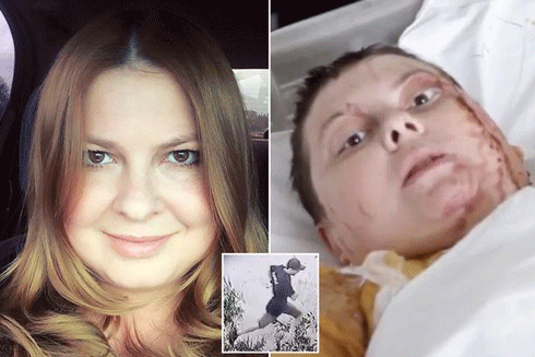 Đòn trả thù hèn hạ bằng axit nhằm vào nữ Phó Thị trưởng chống tham nhũng ảnh 1 Đòn trả thù hèn hạ bằng axit nhằm vào nữ Phó Thị trưởng chống tham nhũng ảnh 1