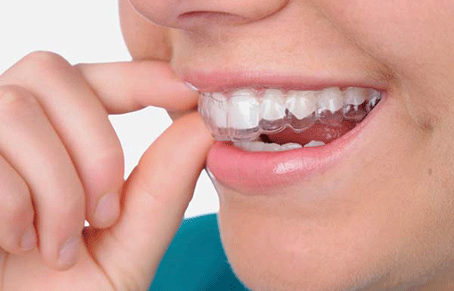 Khắc phục chứng nghiến răng ở trẻ ảnh 1