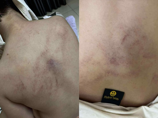 Điều tra vụ bé gái 4 tuổi bị giáo viên mầm non đánh đập, kéo lê, ném vào tường ở phường Bồ Đề