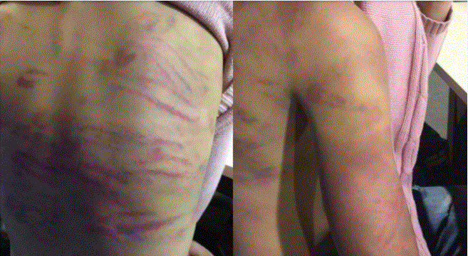 Thu thập được nhiều tài liệu, chứng cứ quan trọng trong vụ việc bé gái bị bạo hành tại quận Hà Đông