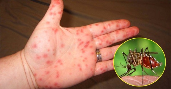 Đã có 3 ca tử vong do sốt xuất huyết, dịch đang vào mùa cao điểm