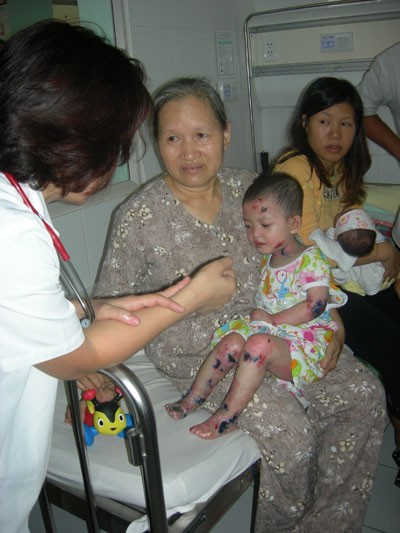 Nhiều bệnh nhi mắc bệnh phồng rộp da hiếm gặp ảnh 1
