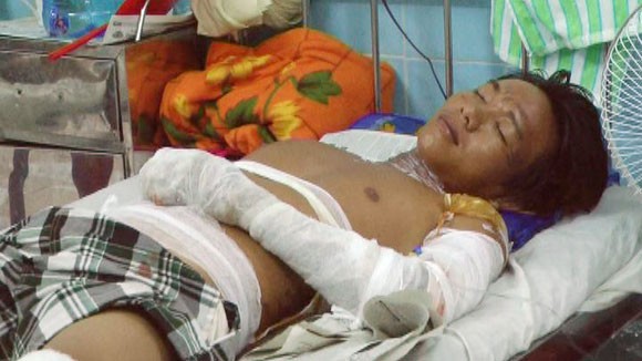 Nổ bồn xăng, 2 người bị thương nặng ảnh 1