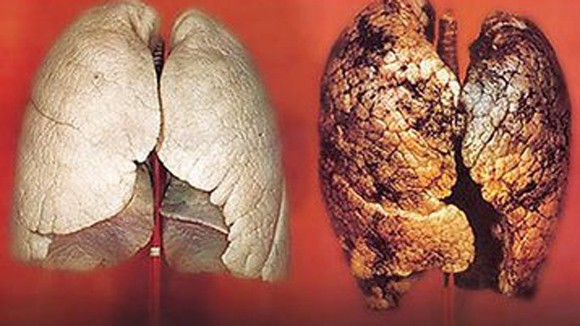 Phương pháp mới điều trị ung thư phổi ảnh 1